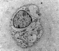 Transmission electron micrograph of nascent regenerative units depicting Schwann cell nuclei and unmyelinated fibres.